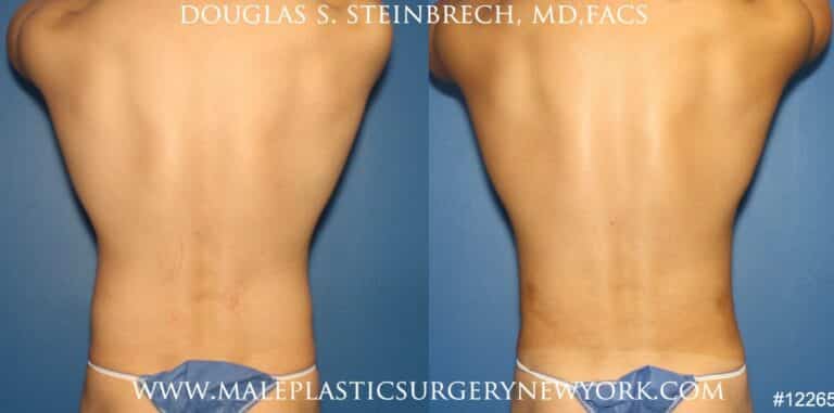 Liposuction to sculpt surfer abs by Dr. Steinbrech