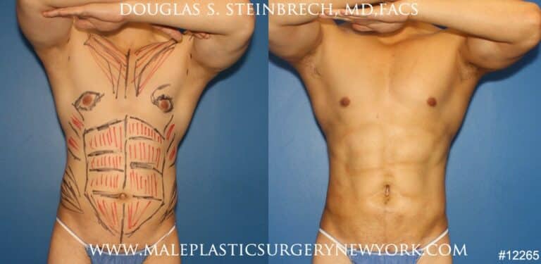 Liposuction to sculpt surfer abs by Dr. Steinbrech