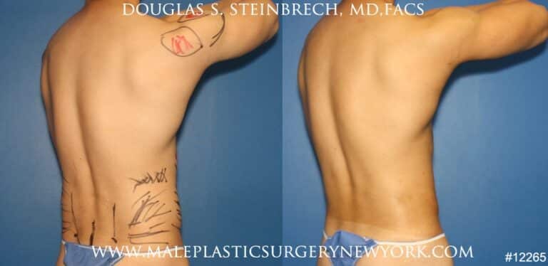 Liposuction to sculpt surfer abs by Dr. Steinbrech