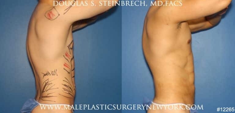 Liposuction to sculpt surfer abs by Dr. Steinbrech