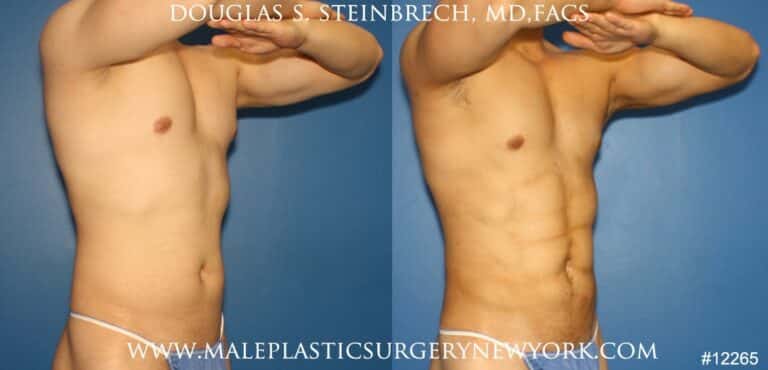 Liposuction to sculpt surfer abs by Dr. Steinbrech