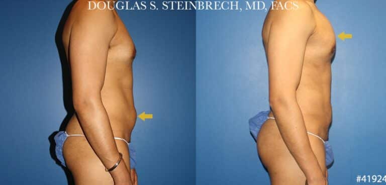 Liposuction with body banking to sculpt the torso by Dr. Steinbrech