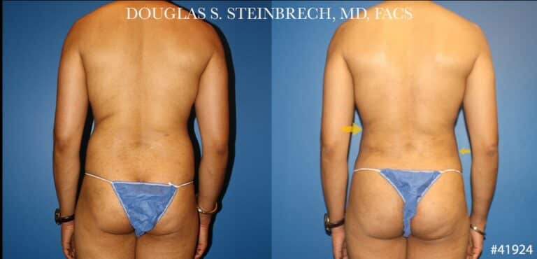 Liposuction with body banking to sculpt the torso by Dr. Steinbrech