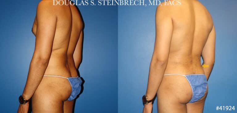 Liposuction with body banking to sculpt the torso by Dr. Steinbrech