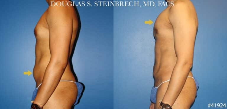 Liposuction with body banking to sculpt the torso by Dr. Steinbrech