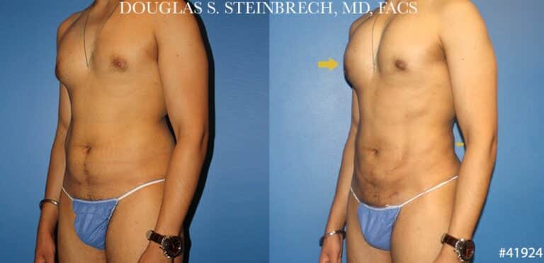Liposuction with body banking to sculpt the torso by Dr. Steinbrech