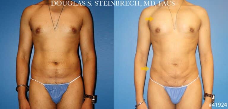 Liposuction with body banking to sculpt the torso by Dr. Steinbrech