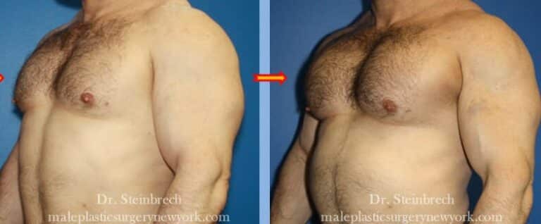 Pectoral implants for chest augmentation by Dr. Steinbrech