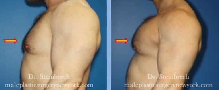 Pectoral implants for chest augmentation by Dr. Steinbrech