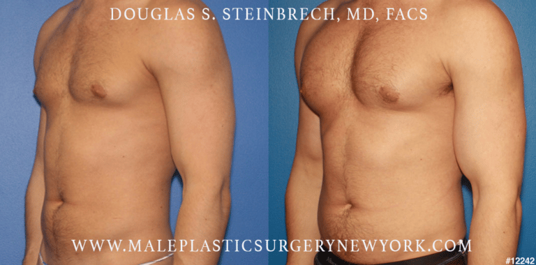 Pectoral and bicep implants for upper body augmentation by Dr. Steinbrech