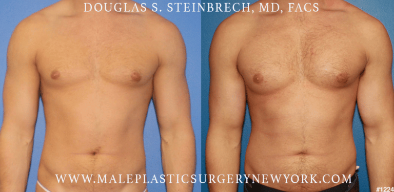 Pectoral and bicep implants for chest augmentation by Dr. Steinbrech
