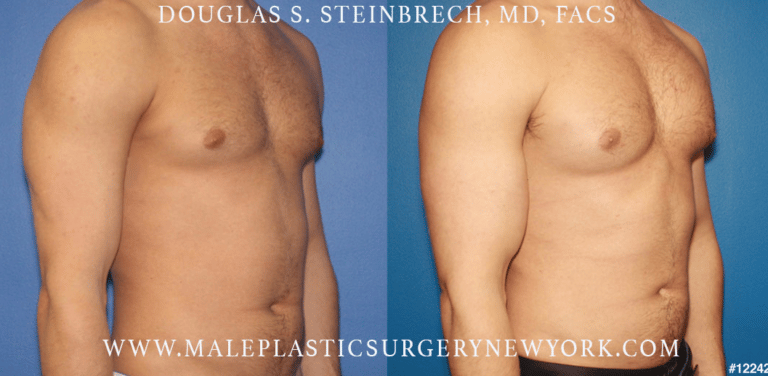 Pectoral and bicep implants for upper body augmentation by Dr. Steinbrech