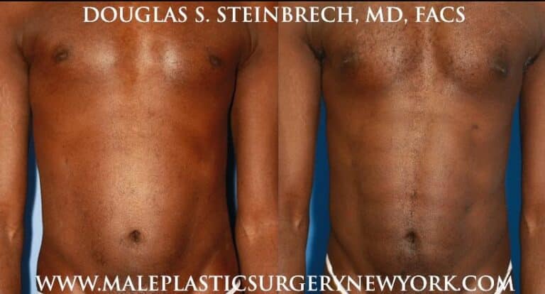 Pectoral implants for chest enhancement by Dr. Steinbrech