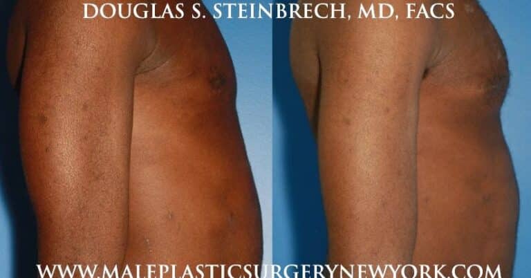 Pectoral implants for chest enhancement by Dr. Steinbrech