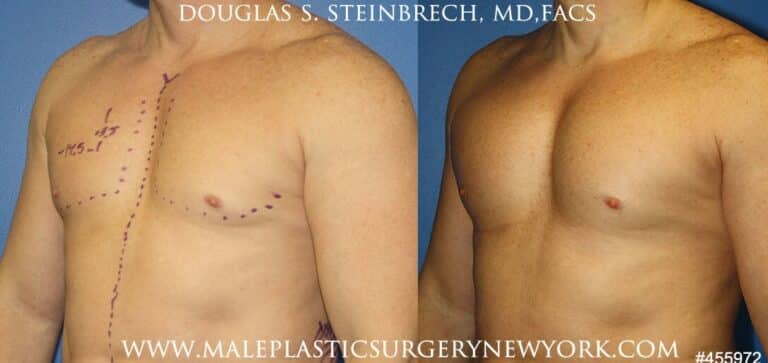 Pectoral implants to augment the chest by Dr. Steinbrech