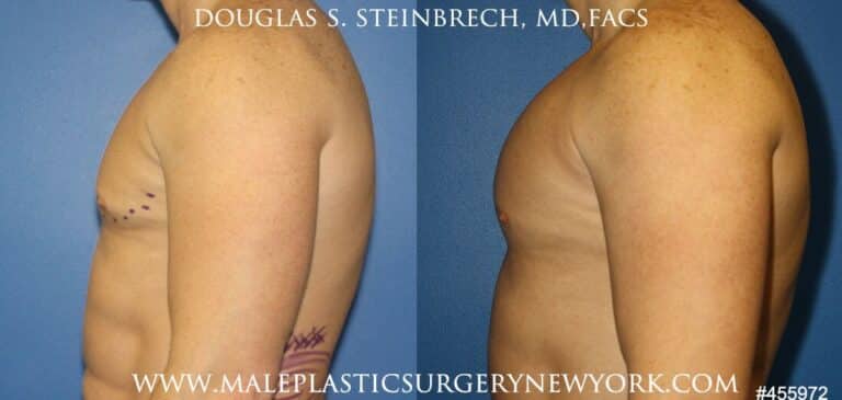 Pectoral implants to augment the chest by Dr. Steinbrech