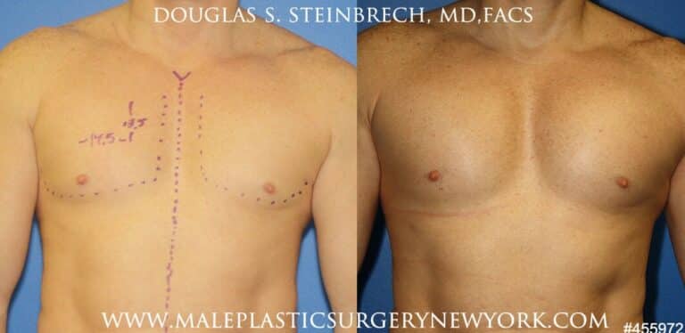 Pectoral implants to augment the chest by Dr. Steinbrech