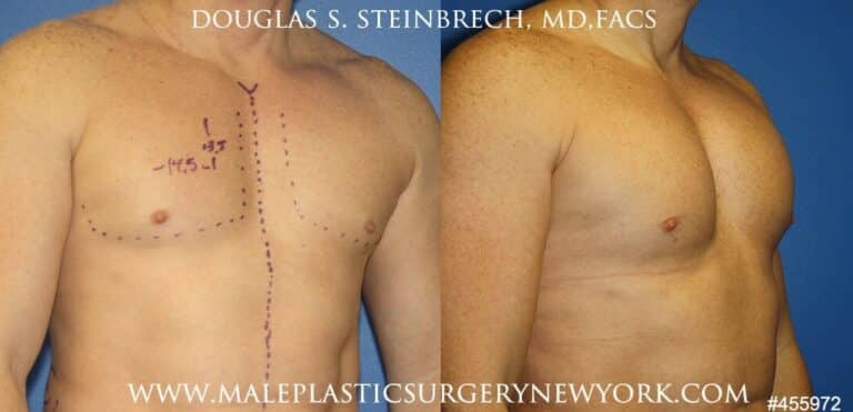 Pectoral implants to augment the chest by Dr. Steinbrech