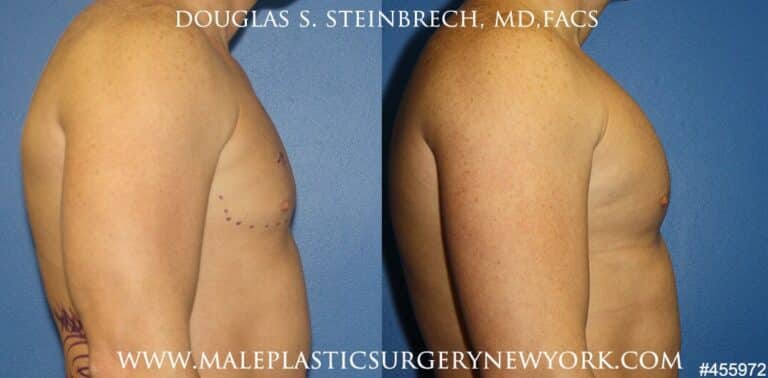Pectoral implants to augment the chest by Dr. Steinbrech