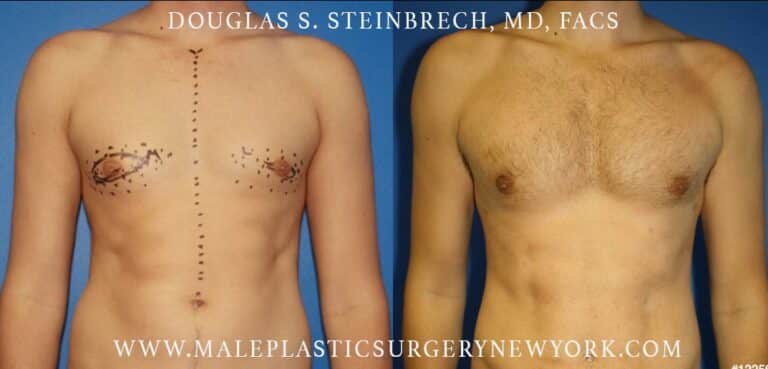 Pectoral implants to sculpt the chest by Dr. Steinbrech