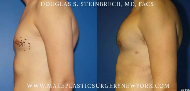 Pectoral implants to sculpt the chest by Dr. Steinbrech