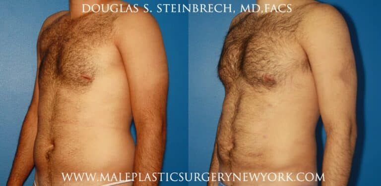 Chest augmentation to treat Poland Syndrome by Dr. Steinbrech