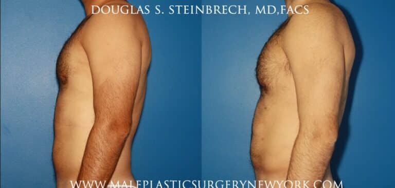 Chest augmentation to treat Poland Syndrome by Dr. Steinbrech