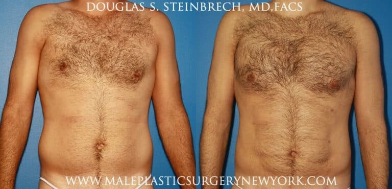 Chest augmentation to treat Poland Syndrome by Dr. Steinbrech