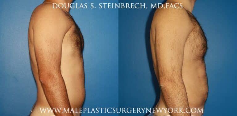 Chest augmentation to treat Poland Syndrome by Dr. Steinbrech