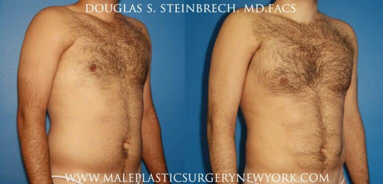 Chest augmentation to treat Poland Syndrome by Dr. Steinbrech