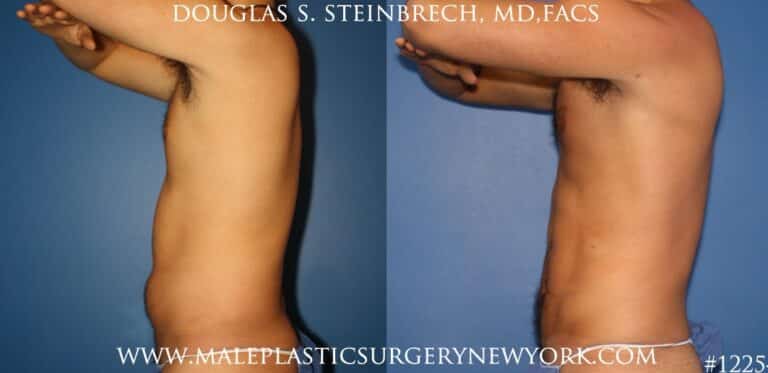 Surfer abs using liposuction by Dr. Steinbrech
