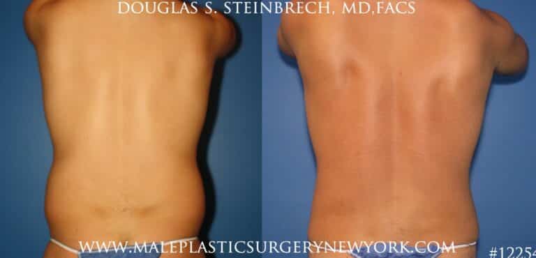 Surfer abs using liposuction by Dr. Steinbrech