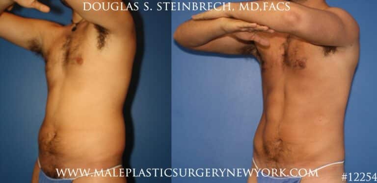 Surfer abs using liposuction by Dr. Steinbrech