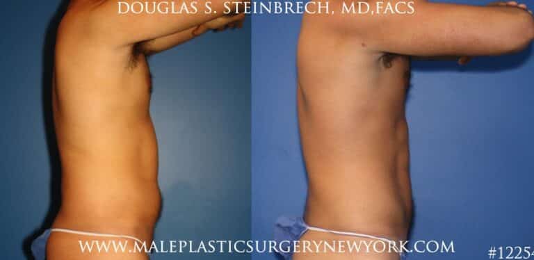 Surfer abs using liposuction by Dr. Steinbrech