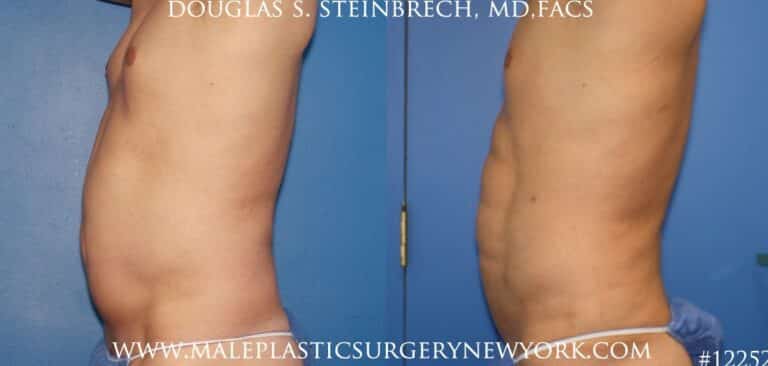 Surfer abs with liposuction by Dr. Steinbrech