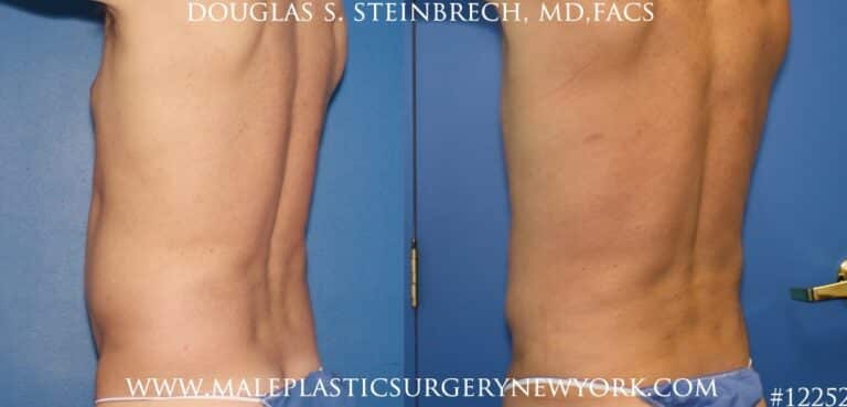 Surfer abs with liposuction by Dr. Steinbrech