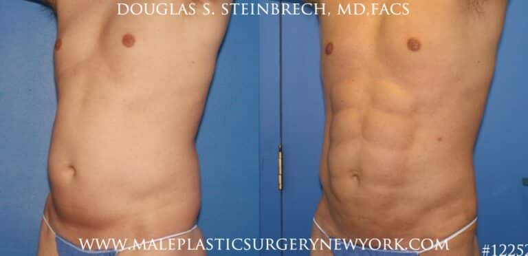 Surfer abs with liposuction by Dr. Steinbrech
