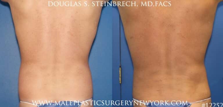 Surfer abs with liposuction by Dr. Steinbrech