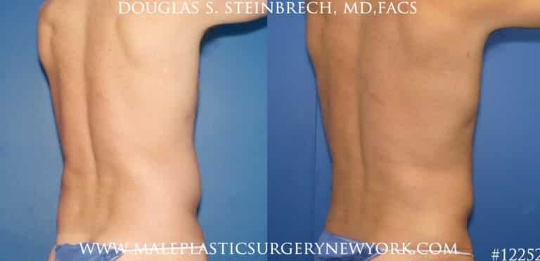 Surfer abs with liposuction by Dr. Steinbrech