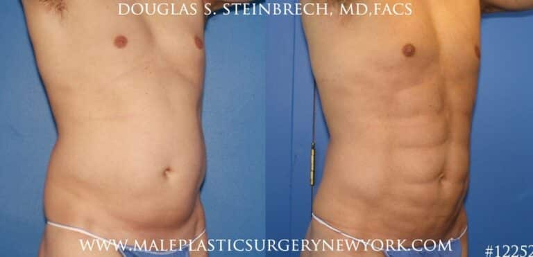 Surfer abs with liposuction by Dr. Steinbrech