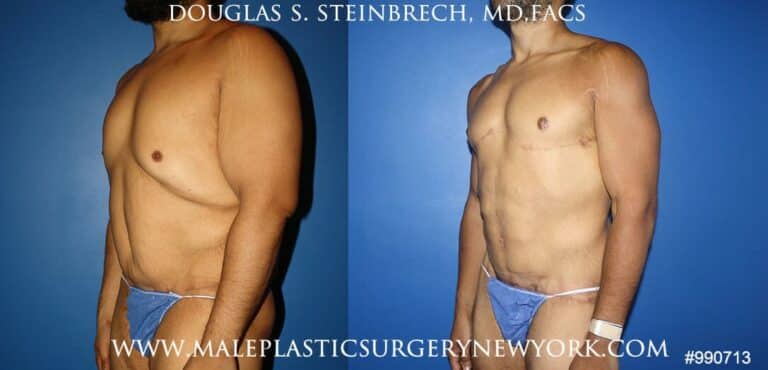 360 Torso tuck after massive weight loss by Dr. Steinbrech