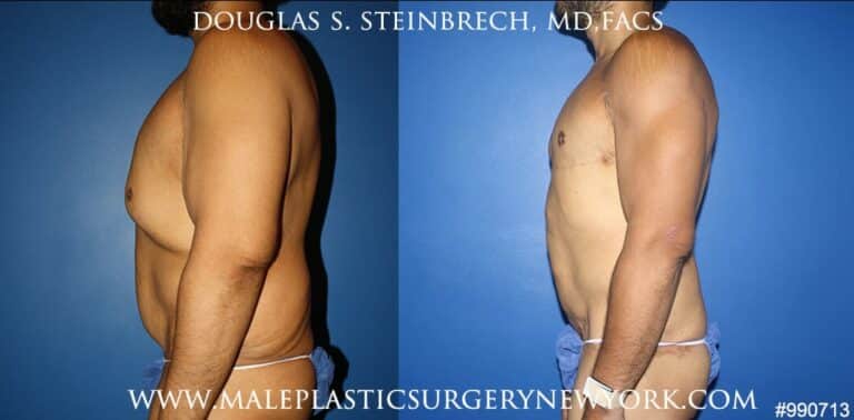 360 Torso tuck after massive weight loss by Dr. Steinbrech
