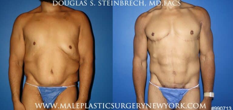 360 Torso tuck after massive weight loss by Dr. Steinbrech