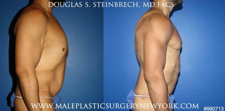 360 Torso tuck after massive weight loss by Dr. Steinbrech