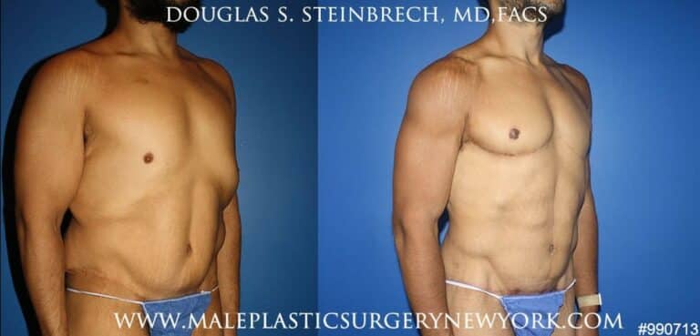 360 Torso tuck after massive weight loss by Dr. Steinbrech