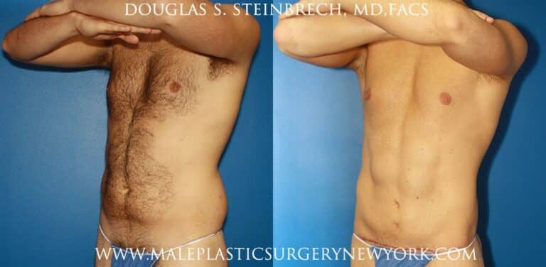 Torso tuck and liposuction for body sculpting by Dr. Steinbrech