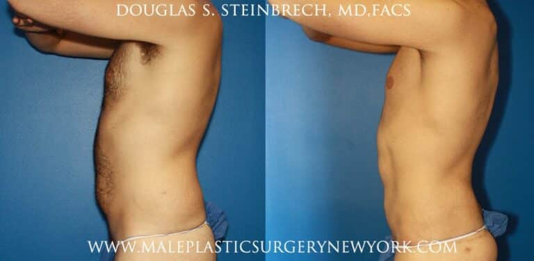 Torso tuck and liposuction for body sculpting by Dr. Steinbrech