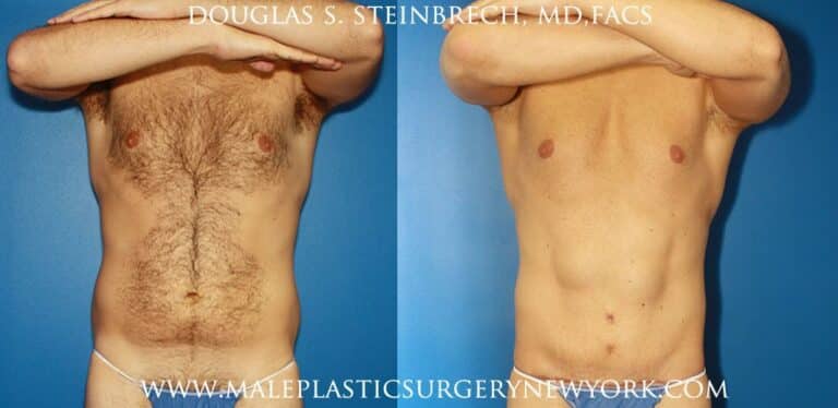 Torso tuck and liposuction for body sculpting by Dr. Steinbrech