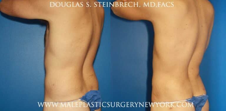 Torso tuck and liposuction for body sculpting by Dr. Steinbrech