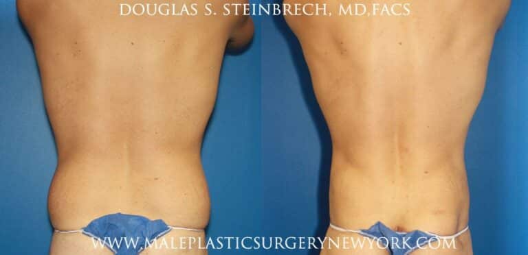 Torso tuck and liposuction for body sculpting by Dr. Steinbrech